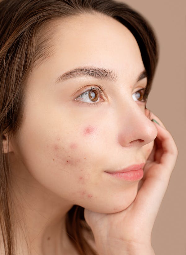 ¿Qué tipo de acné tengo?